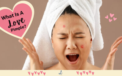 Love Pimples: What They Are and How To Treat Them