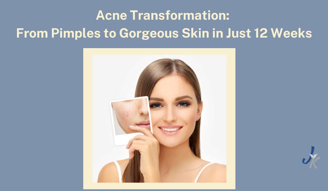 Acne Transformation: From Pimples to Gorgeous Skin in Just 12 Weeks