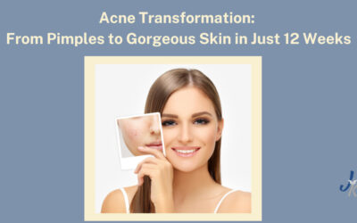 Acne Transformation: From Pimples to Gorgeous Skin in Just 12 Weeks
