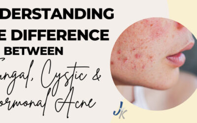 Breaking Down Acne: Understanding Fungal, Cystic and Hormonal Acne
