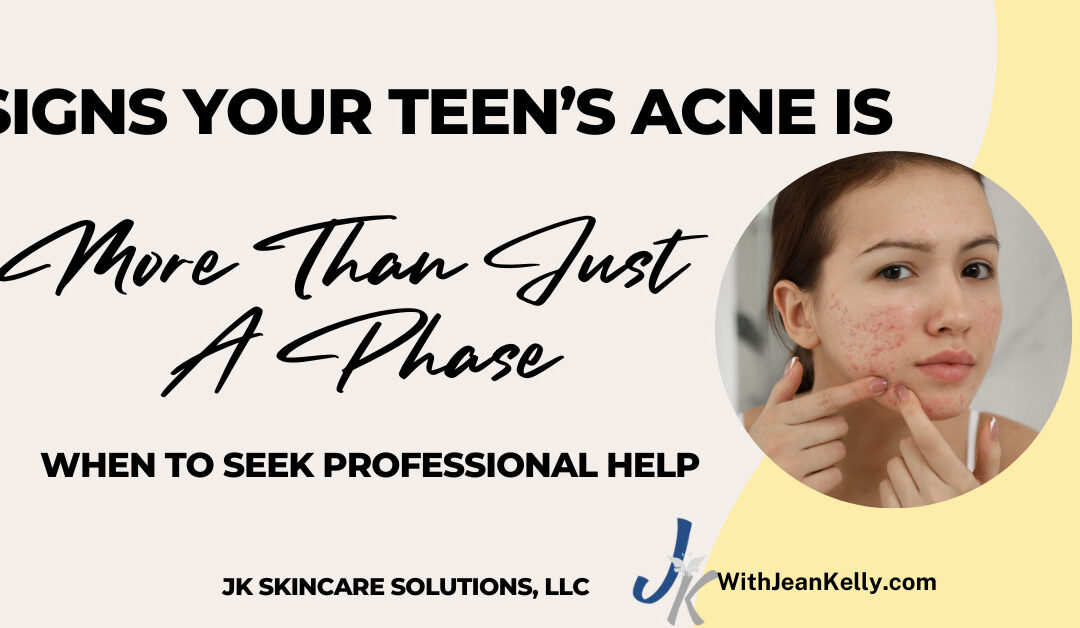 Signs Your Teen’s Acne Is More Than Just a Phase