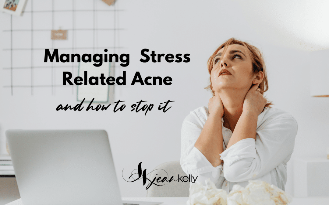 Managing Stress-Related Acne and How To Stop It