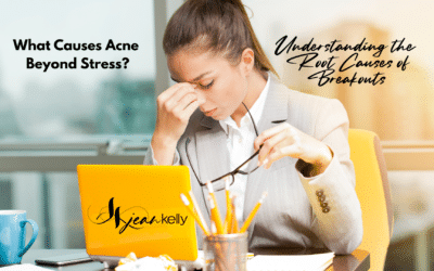 What Causes Acne Beyond Stress? Understanding the Root Causes of Breakouts